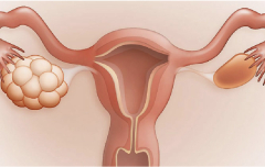 Як аналізи допомагають виявити синдром полікістозних яєчників (СПКЯ)?