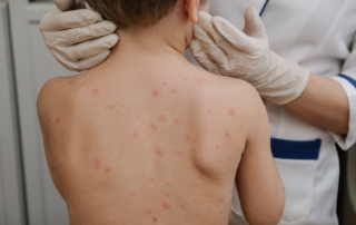 Весняні висипи та шкіра: чи можуть аналізи знайти причину?