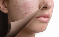 Лабораторна діагностика стану шкіри: які аналізи здати при акне, висипах або випадінні волосся?